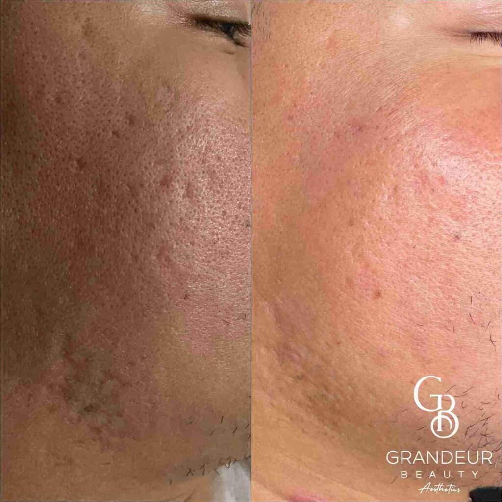Grandeur Beauty Before and Afters with Procell Microchanneling